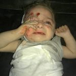 طفلة جريحة من مجزرة أرمناز بإدلب بقصف القوات الروسية 29 9 2017
